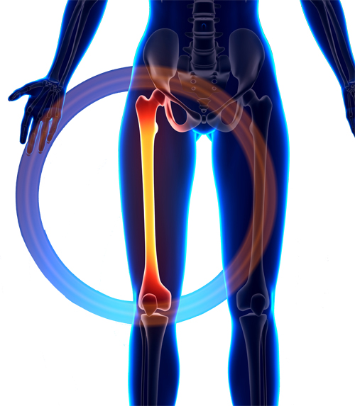 Syndrome de la bandelette ilio-tibiale